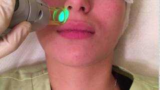 Laser hair removal upper lip with the Alexandrite GentleLase Pro.