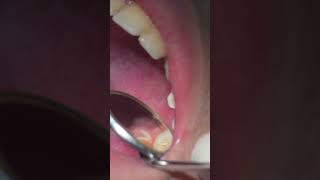 CARIES removing from First Uppr  premolars #dentist #shorts