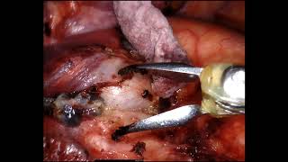 Robotic Mediastinal Lymph Nde Dissection: Station 10L