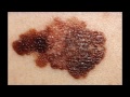 კანის კიბოს ამსახველი ფოტოები skin cancer pictures