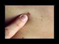 კანის კიბოს ამსახველი ფოტოები skin cancer pictures