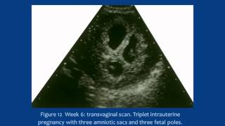 Overcoming challenges in Female and Male Infertility by assisted reproductive technology