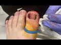 cutting out ingrown toenail