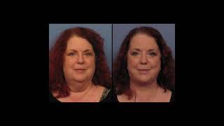 Facelift \u0026 Eyelid Surgery Before \u0026 After | Dr. Eric Mariotti | Case #389