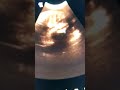 Duodenal atresia Double bubble sign ultrasound sonography