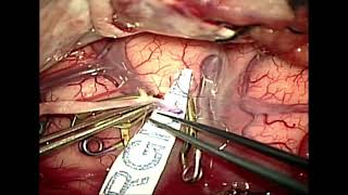 Left cavernous ICA giant aneurysm; EC-IC bypass and ligation of ICA at neck