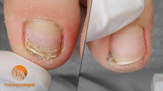 Cleaning of lateral and frontal grooves to fully decompress the nails and relieve his fingers