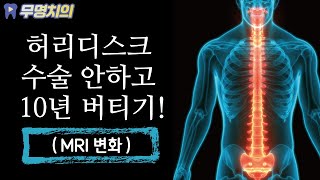 허리디스크 수술 안하고 10년 버티면 어떻게 될까?