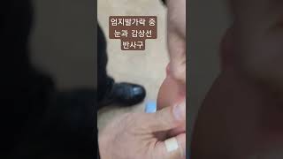 엄지발가락 중 눈과 갑상선반사구