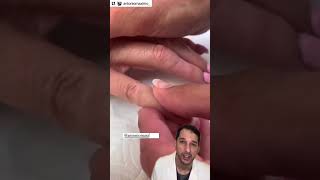 Amazing prosthetic work!#Prosthetic #Finger #Nurse #Dr #Amputation #Artist #Art #Education #Medical