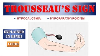 Trousseau's Sign | Hypoparathyroidism | Hypocalcemia | Practical on Patient |