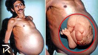 10 Strange Things Found Growing Inside People