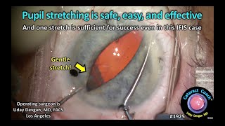 CataractCoach™ 1925: pupil stretching is safe, easy, and effective