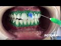 Potenza Bianco Pro SS 38% - Clareamento Dental em Consultório