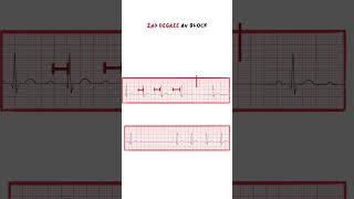 Wenckebach \u0026 Mobitz/ 2nd degree AV Block #ecg #medicine #medical #medicalstudent #doctor #nurse