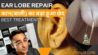 Ear lobe repair कान के छेद बड़े होने पर/बाली से कटने पर क्या?कटे हुए कान को चिपकाए या ऑपरेशन कराएं?