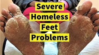 Feet Problems of the Homeless - Severe Calluses and Fungal Skin Infection - Doctor’s POV