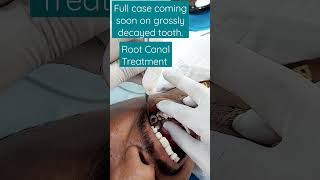 #rootcanaltreatment #toothcavity @JawTooth