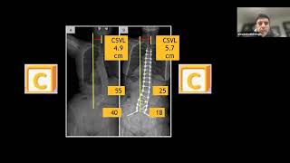 Coronal Alignment in Adult Spinal Deformity : Alekos Theologis, MD - March 10, 2023