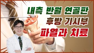 내측 반월 연골판 후방 기시부 파열과 치료 | 건국대학교병원 무릎관절센터 이동원 교수