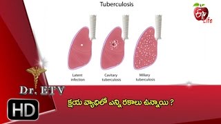 Dr.ETV - Pulmonary tuberculosis - 8th June 2016 - డాక్టర్ ఈటివీ