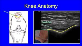 Overview of Ultrasound Guided Injections for Pain Relief