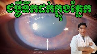 ជំងឺ ទឹកដក់ក្នុងភ្នែក​​   Glaucoma by Dr.Bun laysophea