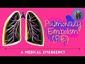 Explains the pulmonary embolism | What is pulmonary embolism | Blood Clot in Lungs