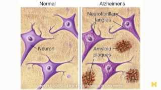 Mining the Causes of Alzheimer's