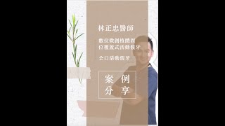 林正忠醫師-鍾婆婆的數位微創植體固位覆蓋式活動假牙＆全口活動假牙 案例分享