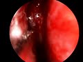 nasal polyp video 2