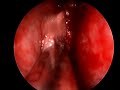 nasal polyp video 2