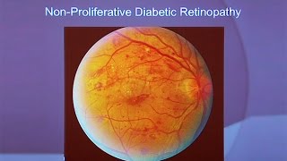 Eye Disease: An Avoidable Complication of Diabetes