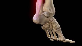 Achilles Tendon Rupture | Complete Anatomy