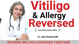 Vitiligo \u0026 Allergy-Reversed? 90 Days [Case Study] 18 Yrs Old