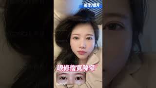 双眼皮术后恢复情况|术后3个月|眼修复|宽改窄👀🈶