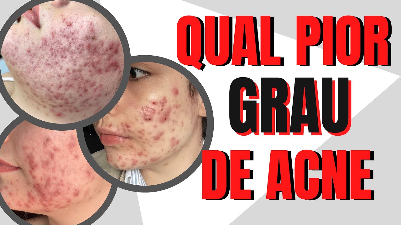 SURPREENDENTES 4 PRINCIPAIS GRAUS De ACNE E TRATAMENTOS Para Cada Um ...