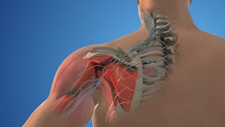 Posterior Cervical Decompression Surgery - Medical animation video