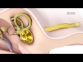 how do cochlear implants work the synchrony cochlear implant med el