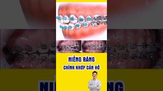 Đây là cách NIỀNG RĂNG chỉnh khớp cắn hở  #nhakhoa #bacsidieutaithu #niengrang