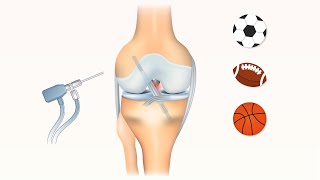 Second ACL revision vs nonsurgical management