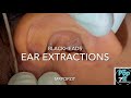 blackheads in the ear. ear extractions. oily plugs extracted. full face video coming soon. mrpopzit