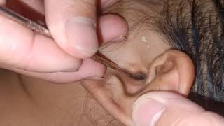 귀지 제거 영상 ( greatest ear wax removal at home)