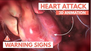 Recognizing A Heart Attack  3d Animation