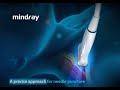 Ultrasound Guidance - eSpacial Navi by Mindray (Medical Device 3D Animation)