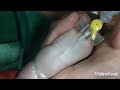 مهارت تطبیق کنول در اطفال خیلی آسان است. iv canulla insertion for children