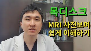 목디스크 MRI 사진보며 쉽게 이해하기!