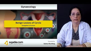 Benign Lesions of Cervix - Elongation Of Cervix