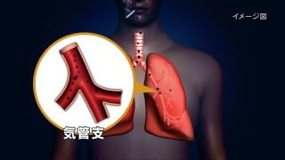 COPD（慢性閉塞性肺疾患）を知る～あなたの肺、おいくつですか？～(3.COPDの発症メカニズム)