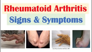 Rheumatoid Arthritis (RA) Signs & Symptoms (& Associated Complications)